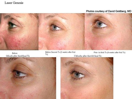 Laser Genesis for redness and pores