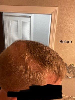 Before hair transplant