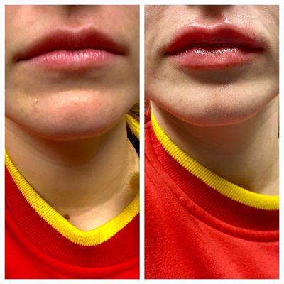 Lips before and after