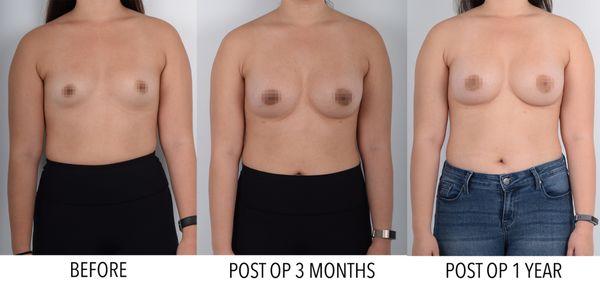 Breast Surgery patient. 3 months and 1 year post op.