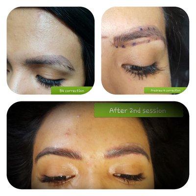 Brow correction and reshaping