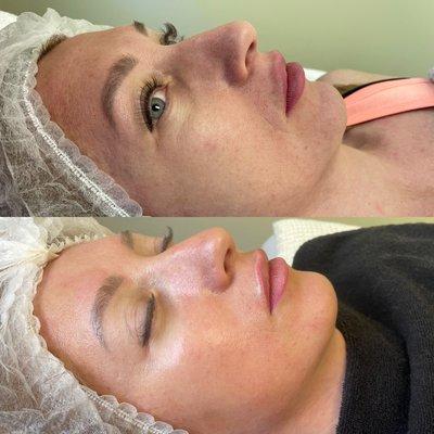 HydraFacial