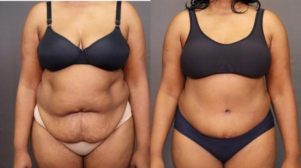 Tummy tuck in New Bern, NC by Dr. John Zannis body contouring expert