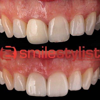 replace old existing centrals with perfect matching veneer