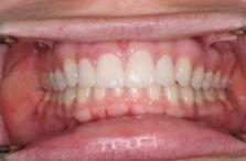 After: Veneers