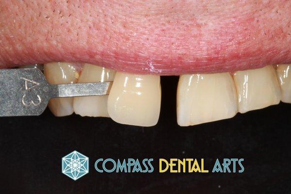 Dr. Wu comes from a painting background and Dr. Lai comes from a sculpting background.  At Compass Dental Arts we create the art of science.