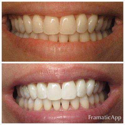 Before and after teeth whitening