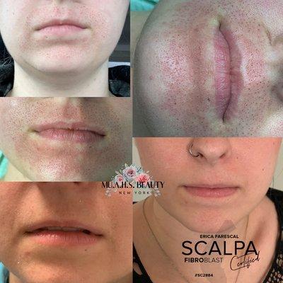 Fibroblast skin tightening- Lip Flip (Lip Lift). 5 days healed. Before and after photos.