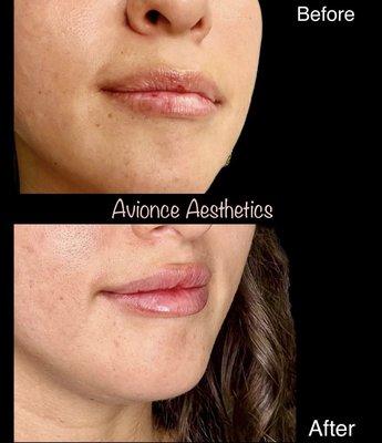 1 Syringe Lip Filler Using Juvederm Volbella