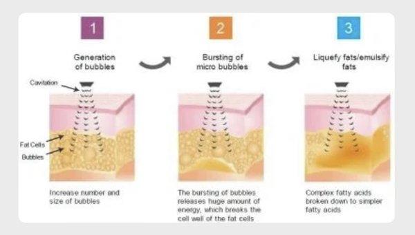 Breaking down fat with Cavitation and RF!!