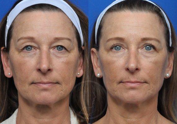 This patient was treated with upper blepharoplasty/ eyelid surgery at Garcia Facial Plastic Surgery.