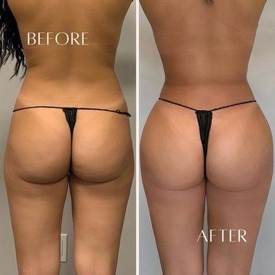 Liposuction of the midsection with fat transfer by Dr. Gevorgyan!