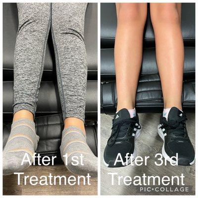 Young athlete that was given a heel lift in her right shoe. Now after 3 treatments she does not need the lift anymore!