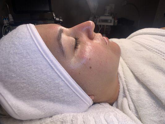 Hydrafacial Glow