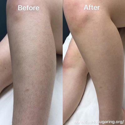 Legs Sugaring