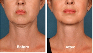 Kybella before and after