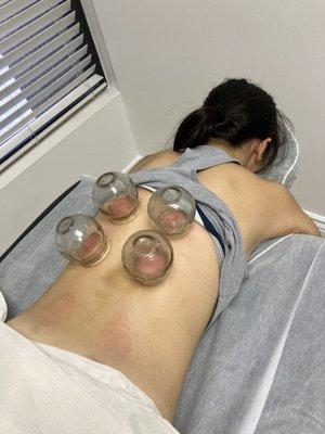 Fire cupping can decrease toxin buildups, promote energy flow, release fascia adhesions, improve blood circulation, help with anxiety & more