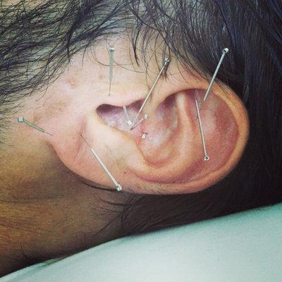 Auricular Acupuncture