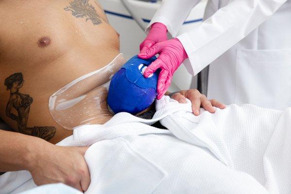 CoolSculpting Treatment