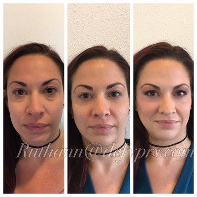 Pt transformation with cheek filler, under eye filler, and jawline filler