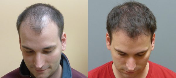 Before and 7 months after Neograft Hair Transplantation in Savannah. Photo copyrights Dr. E. Ronald Finger. 2000 grafts