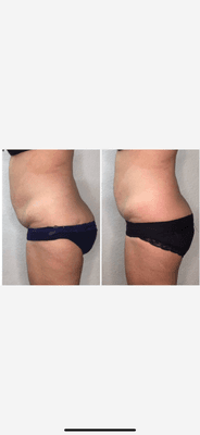 Cryo Sculpting, Tighten  loose Skin . Get rid of Fat cells permanently