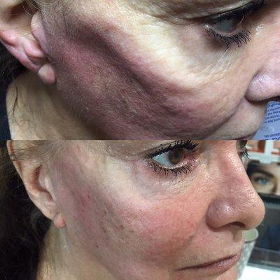 Before and after correction of cheek hollows.  Dramatic, wonderful before and after - using Juvederm.