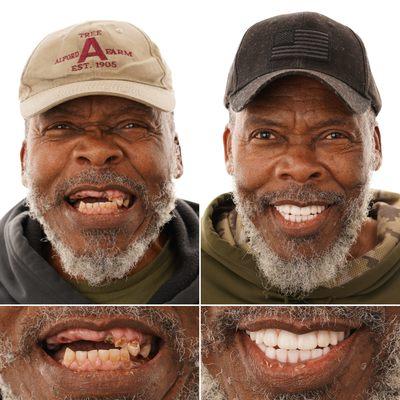 Louisiana Implants and Dentures