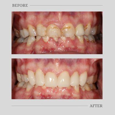 Check out this incredible smile transformation by Dr. Wolfe! Interested in a smile makeover? Call our office today!