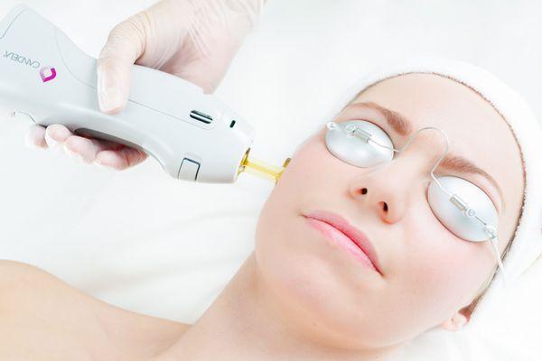 Women's Laser Hair Removal for the sideburns. Takes less than 3 minutes!