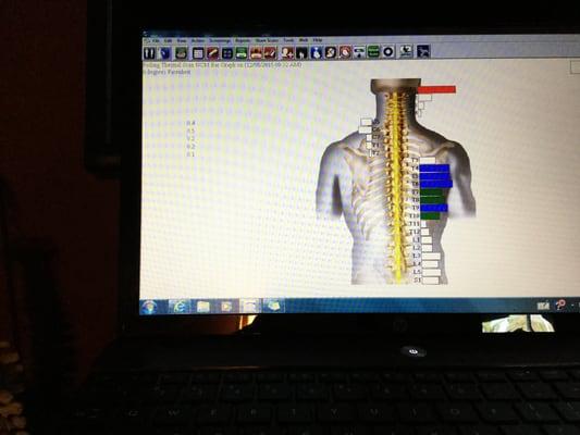 Spinal thermography measuring heat differences between both sides of spine detecting spinal misalignments