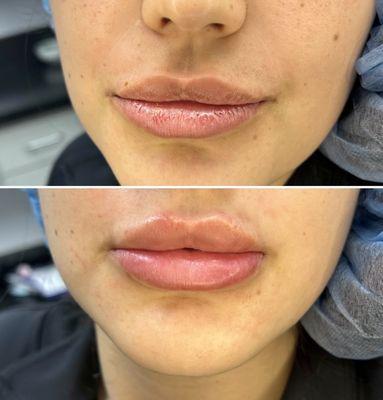 Lip refine