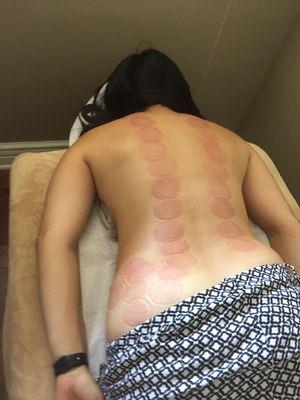 Had my first cupping session today, LOVED IT! Highly recommend a session with Ramona!!!