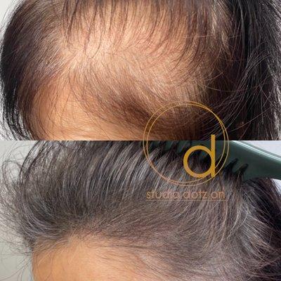 We specialize in Hair density work with smp(scalp micro pigmentaion) scalp tattooing