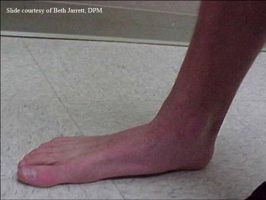 Flat foot deformities