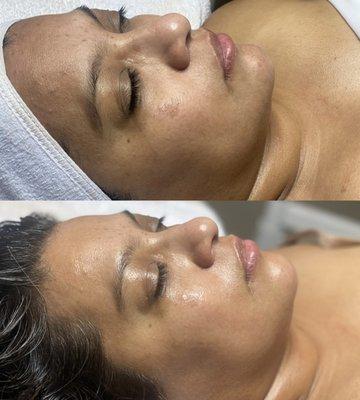 Reduced hyperpigmentation, lifted and plump complexion after one Transform My Skin treatment.