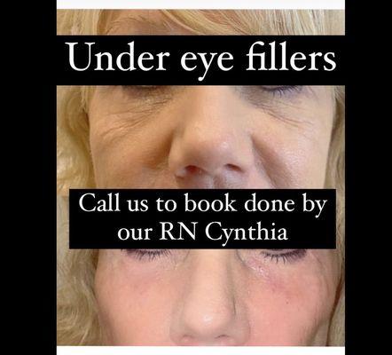 Under eye fillers