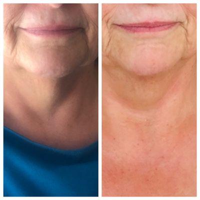 Radiofrequency for lower face contouring and neck skin tightening