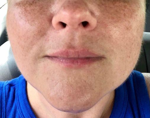 July 27, 3.5 weeks after Restylane lip injections.