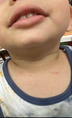 Scratches on baby neck from a different kid finger nails