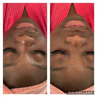 Microdermabrasion facial