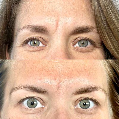 Botox between the brows + brow tox!!