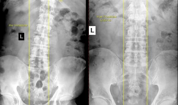 66 year old male.  Former professional athlete and detective with chronic low back pain and sciatica.  After 18 visits!