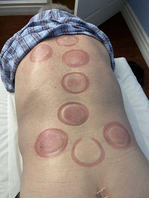 Cupping