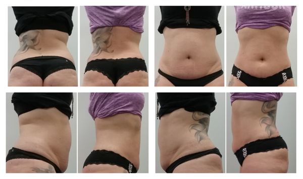 Results after 8 treatments - Laser Lipo