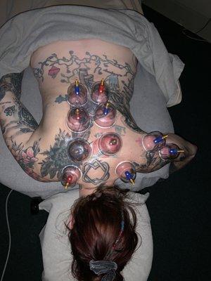 Cupping Therapy