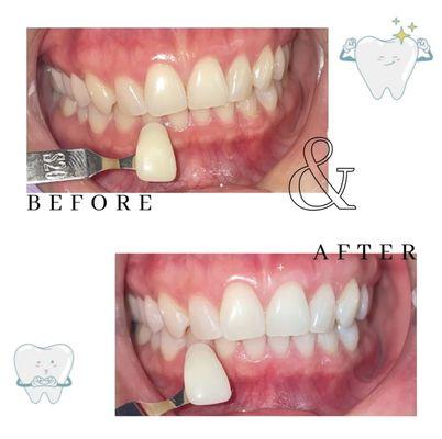 Professional teeth whitening, same days results. Pain free