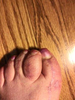 Simple bunion removal and left big toe permanently curved over. Second toe left permanently swollen three times its size!