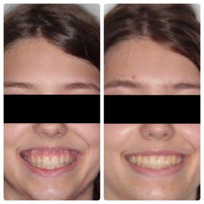 Gummy Smile Reduction Without Surgery