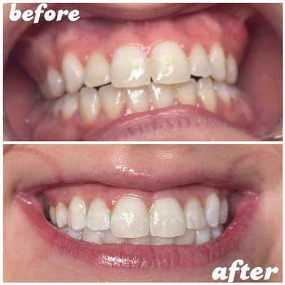 30 minute whitening session